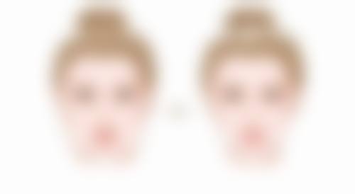 双眼皮术后两月肉条未消：术后护理与修复建议