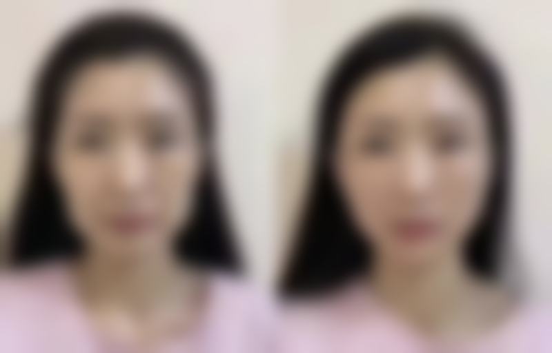 如何巧妙祛除眼袋泪沟？多种方案定制专属改善计划，还你明亮双眸 