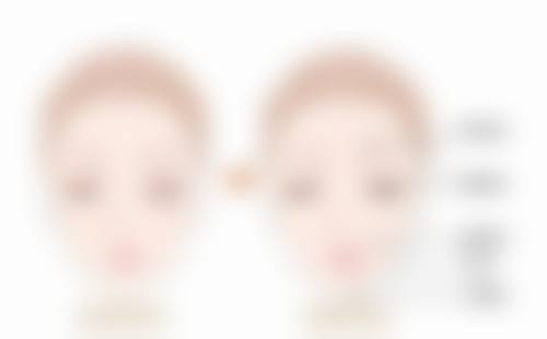 割完双眼皮红色疤痕何时消？选择合适医院特别重要