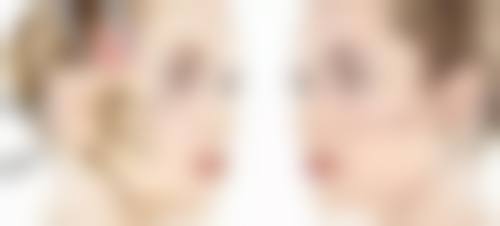 割完双眼皮红色疤痕何时消？美学提示助你修复