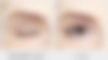 大腿抽脂究竟能瘦多少厘米?选择合适的医院特别关键