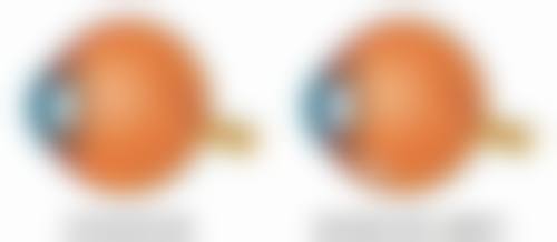 进口国产膨体大比拼：不同膨体材料的适用人群