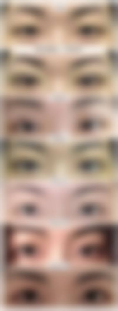 甘露眼部整形实例