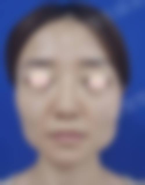 郭军磨骨手术水平怎么样可靠吗?