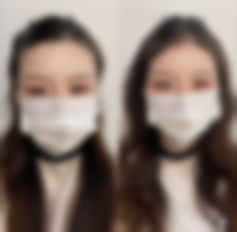 大腿抽脂究竟能瘦多少厘米?手术前后的注意事项