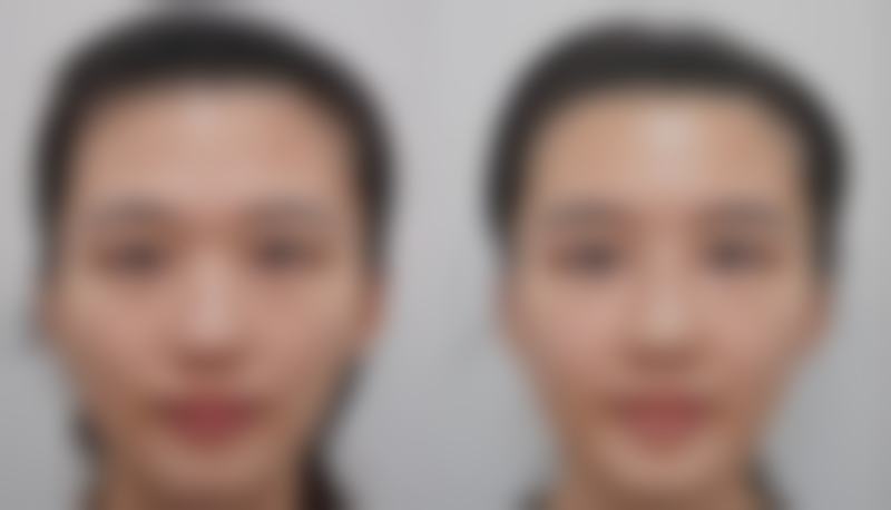 割双眼皮后能喝咖啡吗？总结与温馨提示