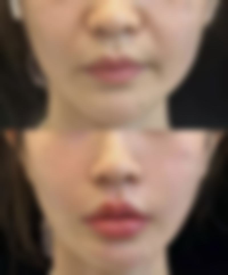 割双眼皮后能喝咖啡吗？医院专精护理攻略大放送