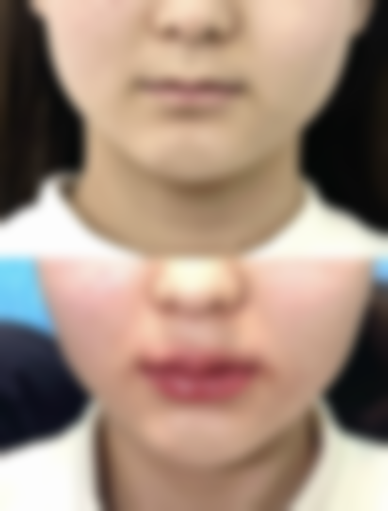 大腿抽脂究竟能瘦多少厘米？揭秘影响瘦腿效果因素与术后理想围度变化 