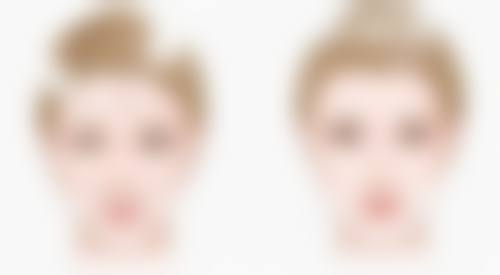 埋线双眼皮宽窄不一能否修复?了解修复时间和护理建议