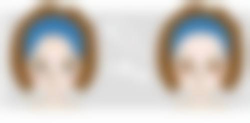 如何减少做双眼皮后眼皮松弛的风险