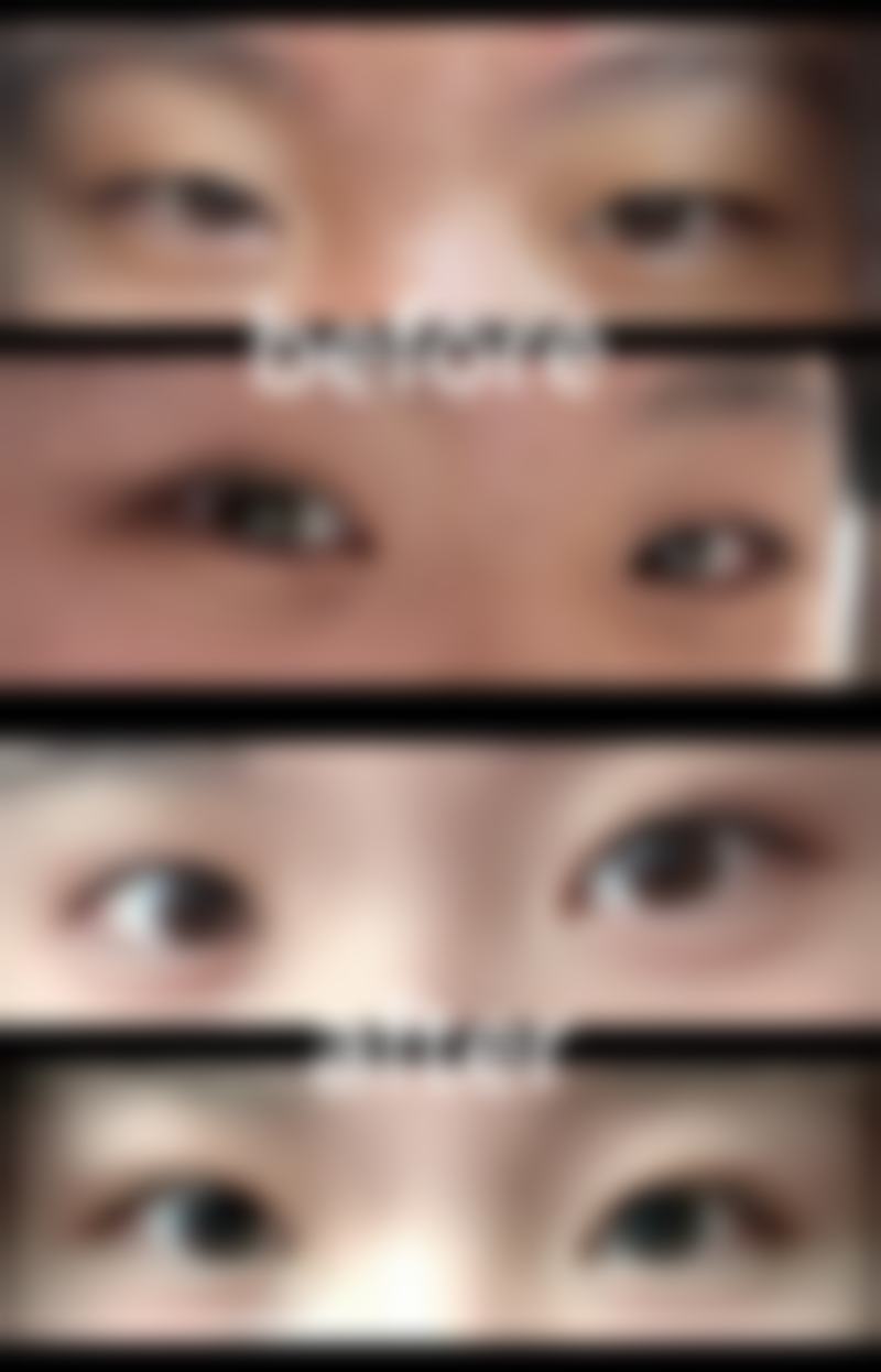 术后修复和护理