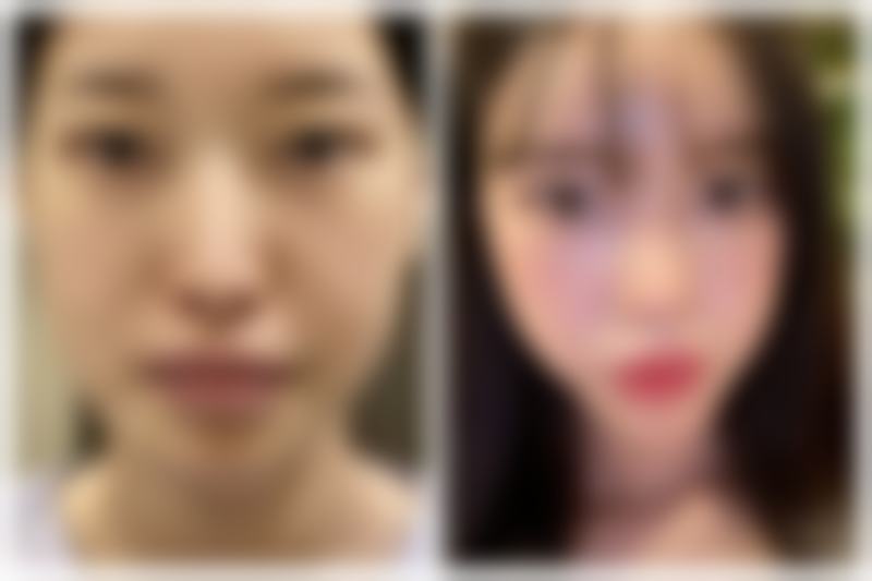 割双眼皮会大出血吗？专业医院多举措控出血，助你安心拥有自然美眼