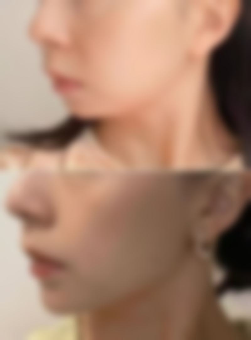 埋线双眼皮宽窄不一能否修复?分析核心原因