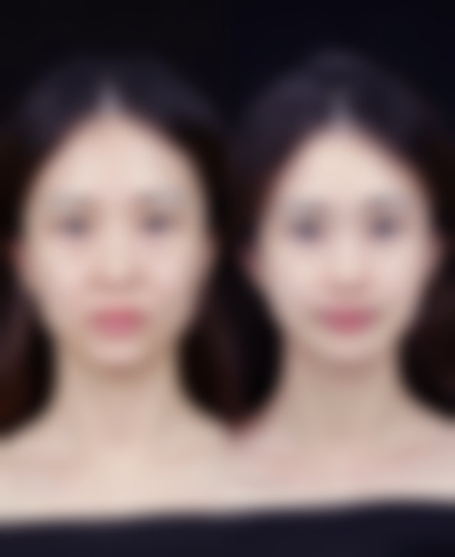 哺乳后至少6个月且结束哺乳3 - 6个月可隆胸，选对时机实现自然持久美胸效果 