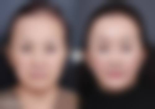 四、武汉曙光植发实例