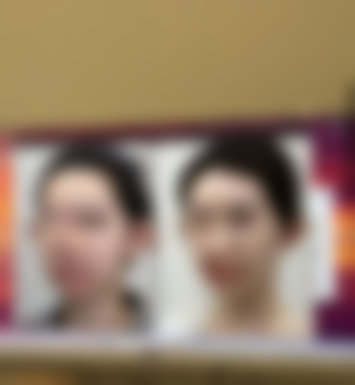 抽脂消肿时间大揭秘:消肿过程的三个阶段