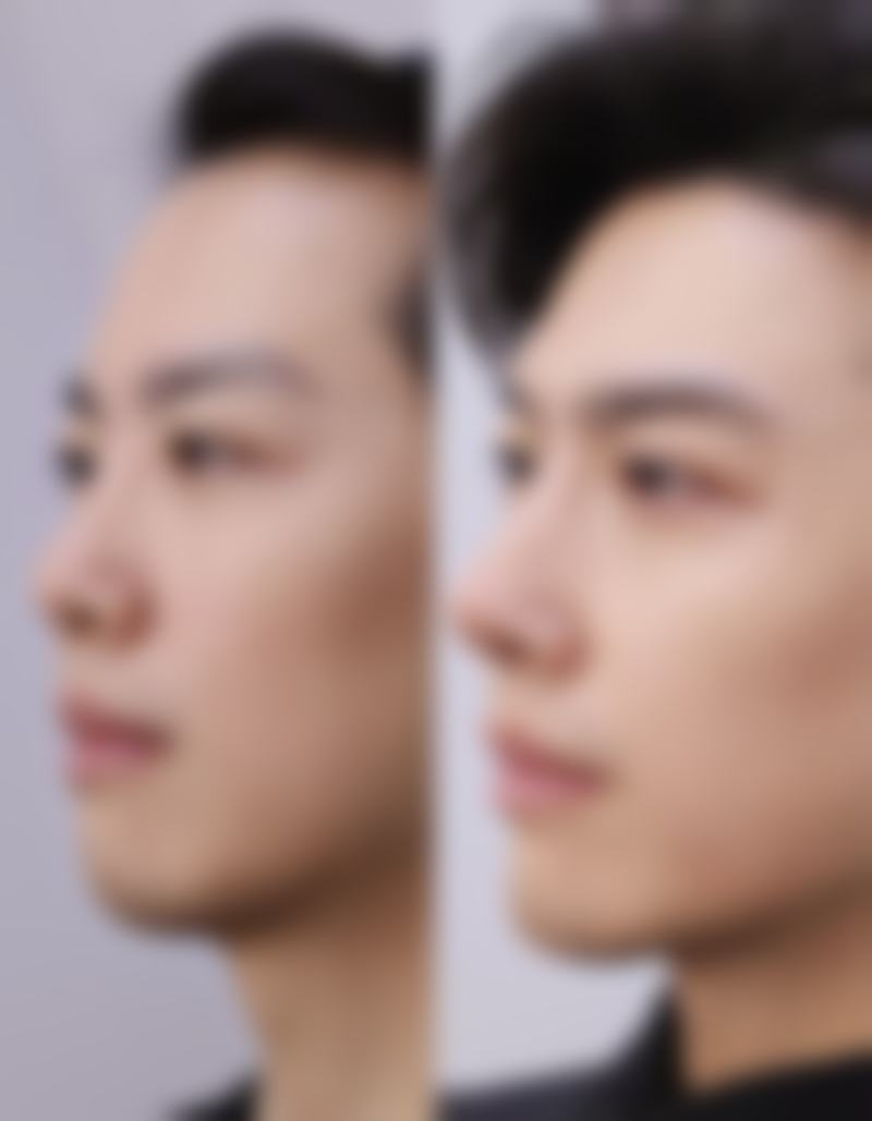 妙招四:选对医院,专精助力告别眼袋