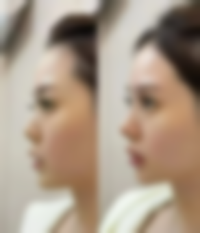 抽脂消肿时间大揭秘：2 至 3 个月逐步恢复，受部位、体质和护理影响 