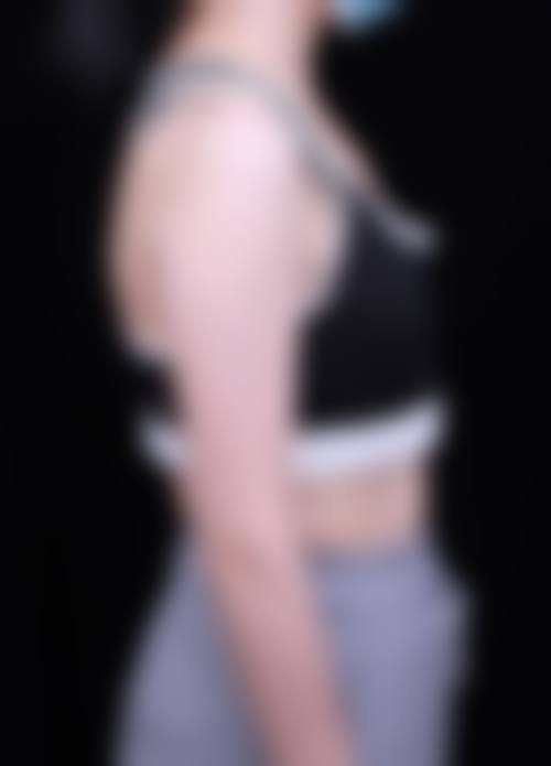 郭承昊隆胸实例