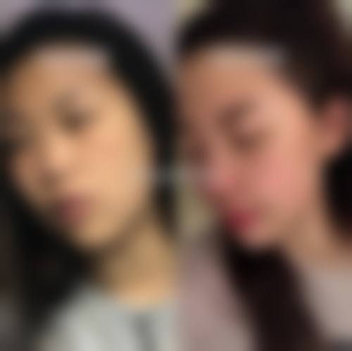 刘庆阳磨骨实例