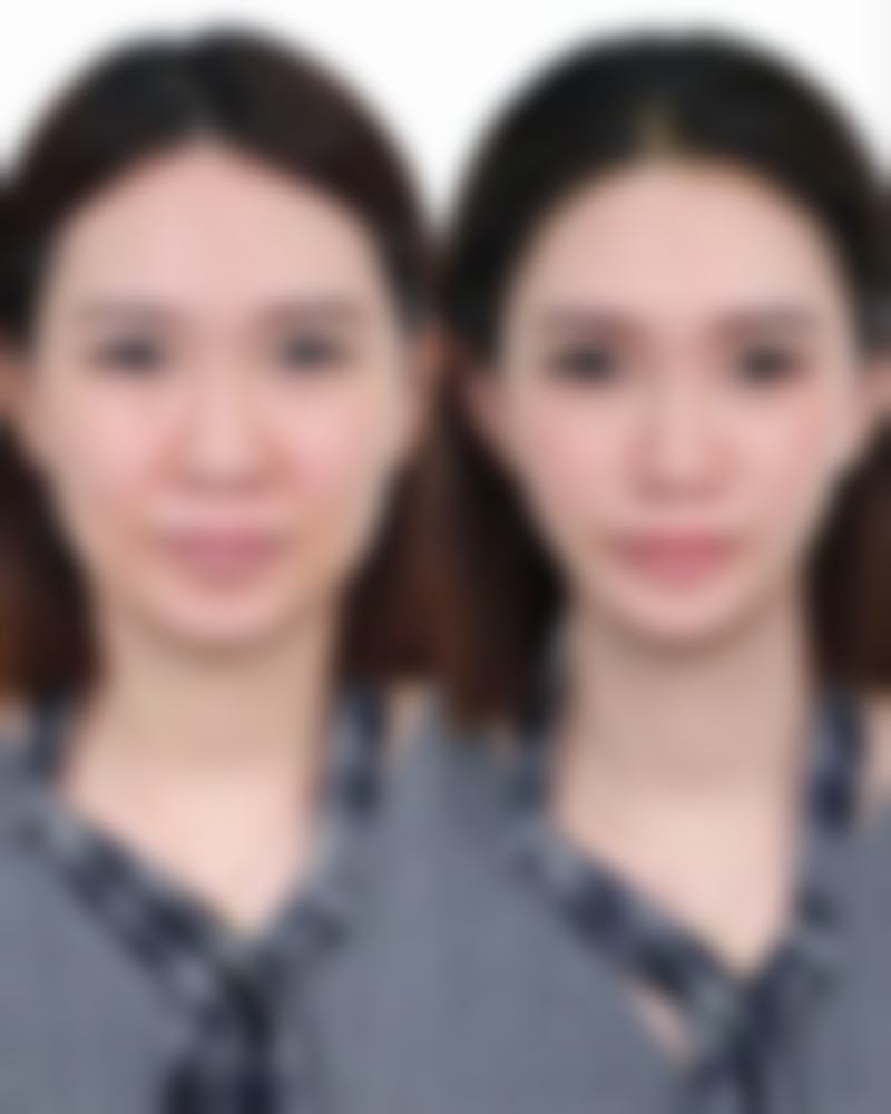 40年烧伤疤痕修复攻略:做好日常护理