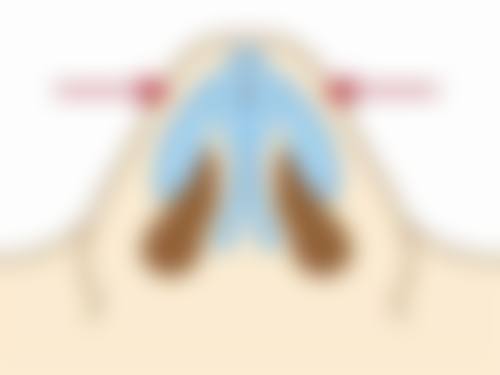 抽脂手术修复时间大揭秘！修复小贴士，让你修复更轻松