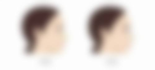 告别重度眼袋有妙招：术后护理，巩固治疗成效