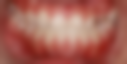 海口爱牙口腔医院矫正牙齿成效咋样？矫正技术精良