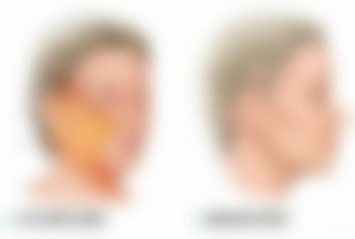 隆鼻的骨粉揭秘：羟基磷灰石人工骨的塑形优势