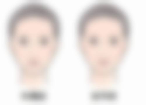 割双眼皮后这些注意事项你知道吗？术后清洁、饮食要点助力快速恢复美眼 