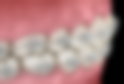 海口爱牙口腔医院矫正牙齿成效咋样？矫正方案个性化