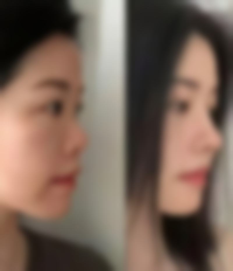 探寻合资隆胸假体有哪些？选择适合自己的才是更好的