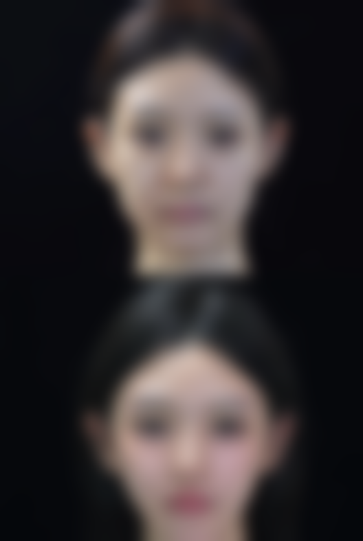 大臂抽脂多久见效果？1 - 3 个月显效，术后护理助力塑造自然美臂