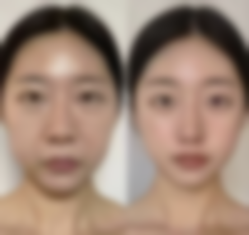 探寻合资隆胸假体有哪些？多种优质品牌，兼具高性价比与个性化定制优势 