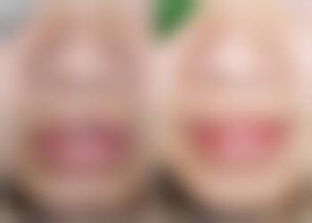 去眼袋攻略：不同类型眼袋的方案选择