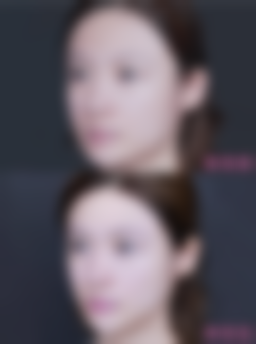 我在北京米兰柏羽丽都做红蓝光祛痘 168元环境好体验舒服痘痘消超快