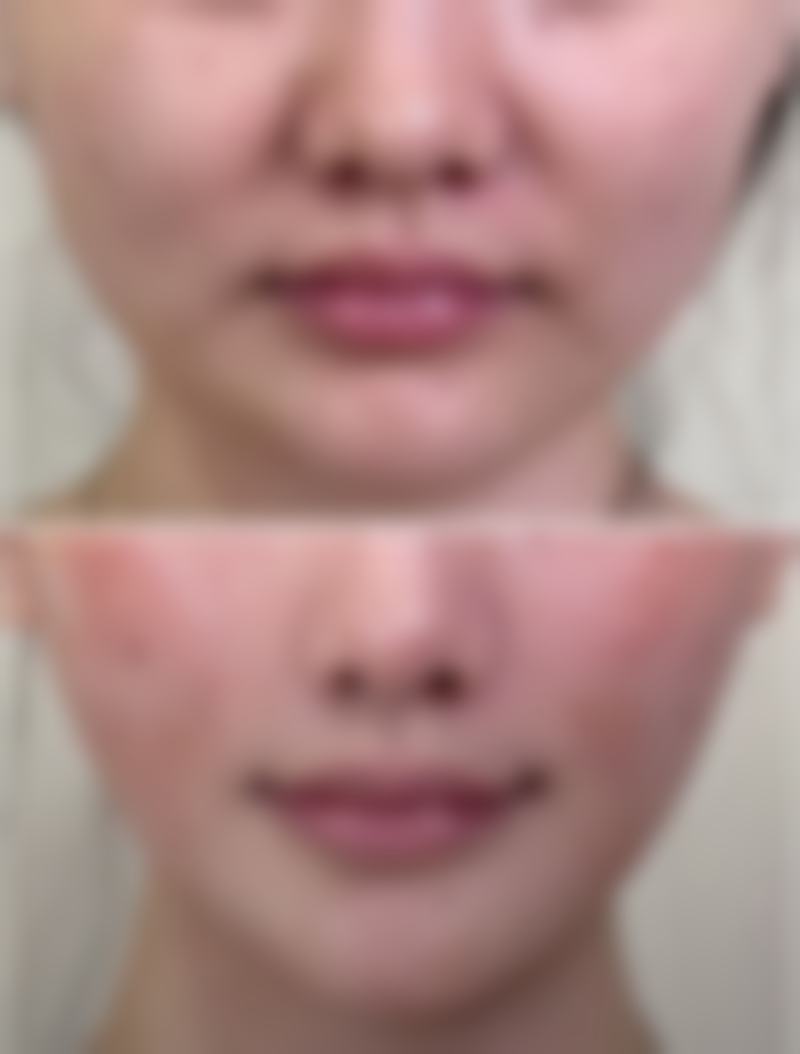 影响瘦脸成效和定型的因素大揭秘