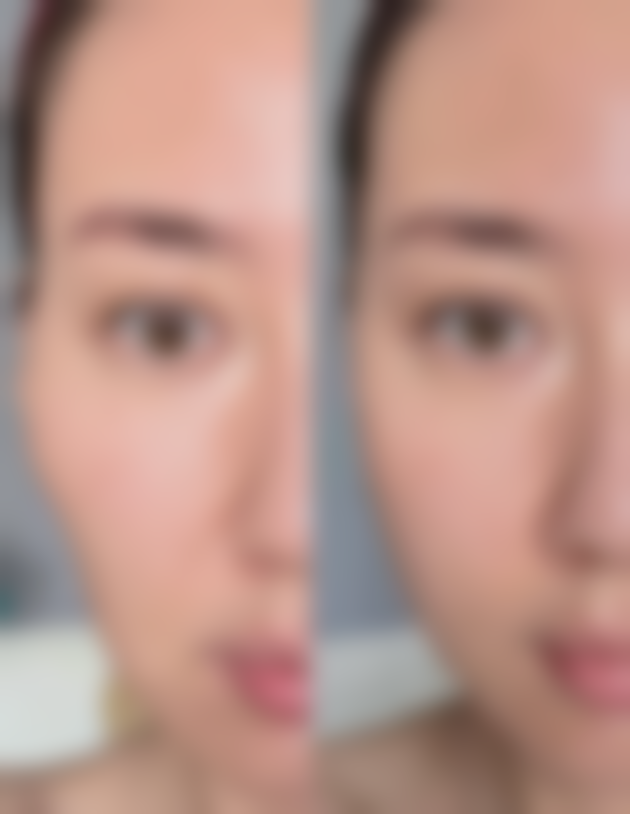 取出隆胸假体要注意啥？术后伤口护理是关键