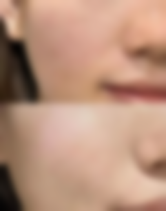 轻微烫伤后红色疤痕这样去除！日常护理方法特别实用