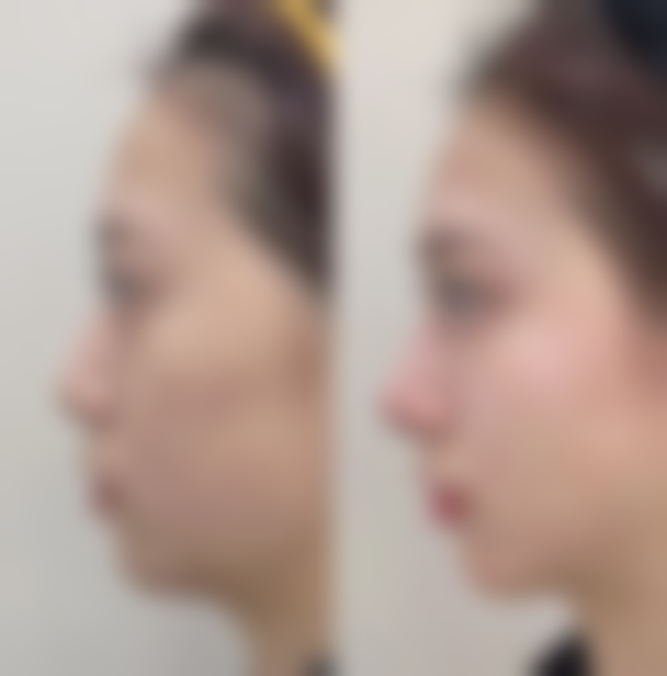 手术做眼袋成效能维持多久？术后护理的关键