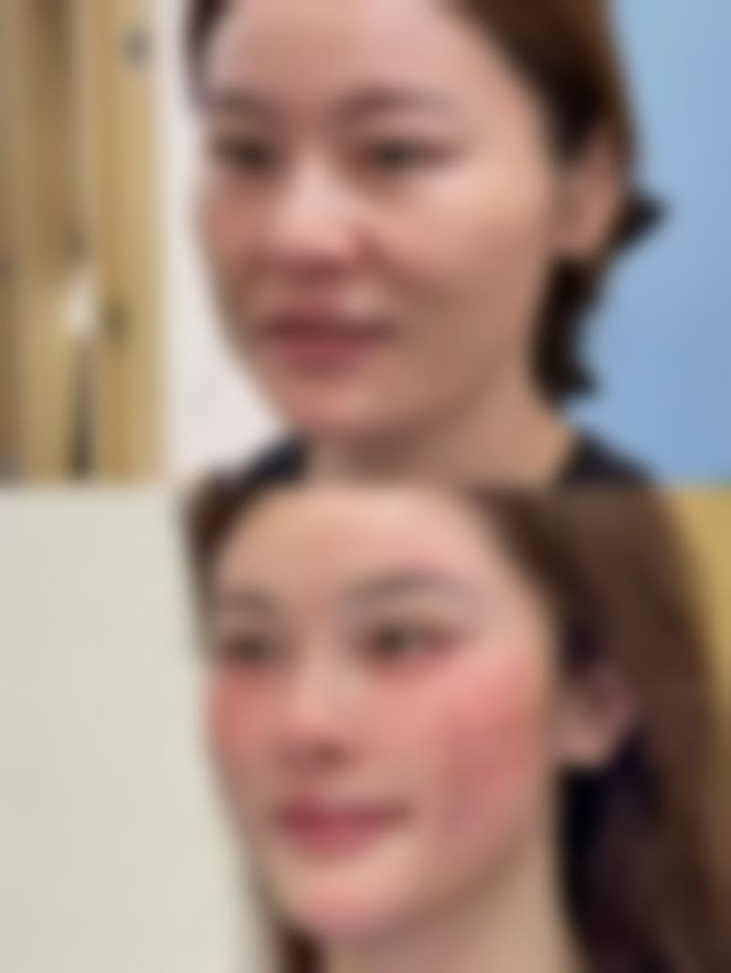 新疤痕激光能否去掉？揭秘激光祛疤优势，多阶段适用助你快速修复疤痕 