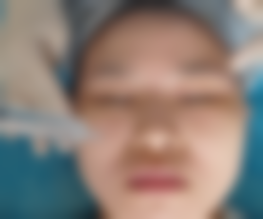 一周后的焕亮惊喜：混油敏皮终于能素颜出门了