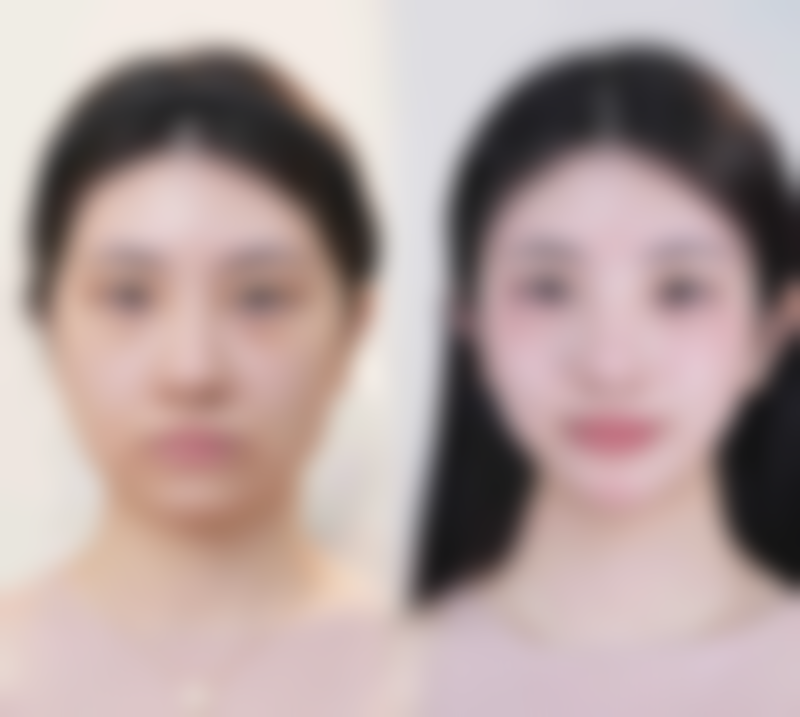 四、威海董立鹏整形医院实例