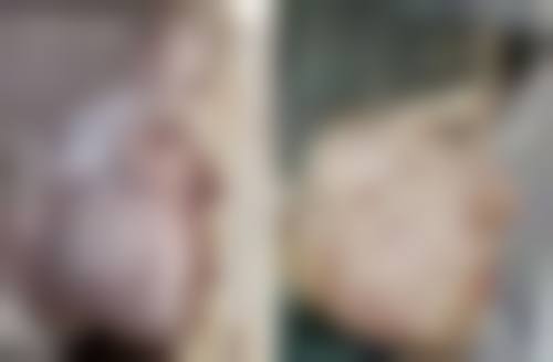 摔伤疤痕色素沉着能祛除吗？多种方法助力淡化色素，还你光滑肌肤 