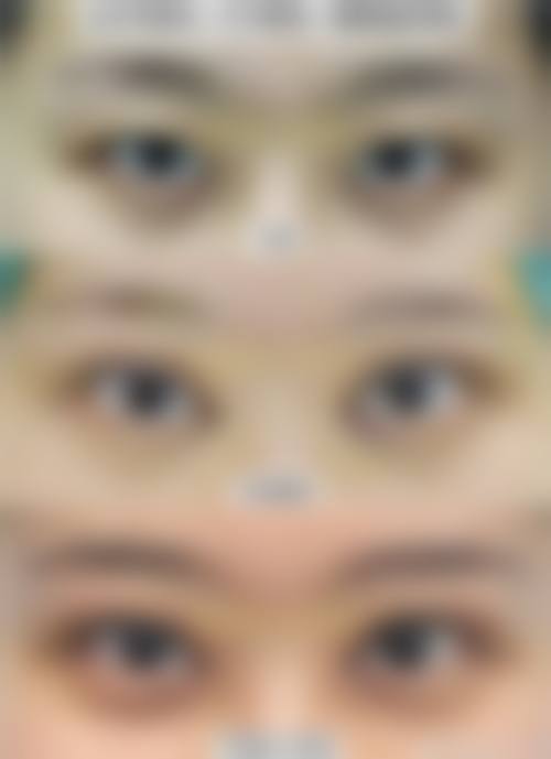 尹栋炫医生双眼皮手术怎么样可靠吗？