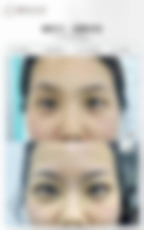 魏晓丹医生双眼皮手术实例