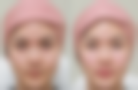 王晓伟医生重睑实例