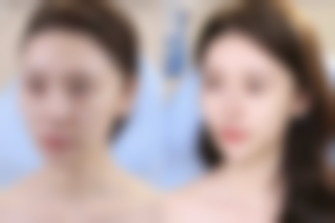 隆胸后假体移位啥感觉？总结及注意事项