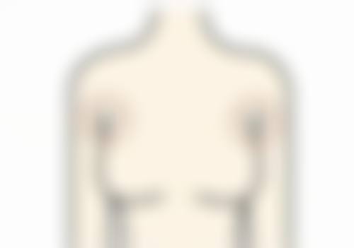 耳朵打耳洞长了疤痕疙瘩咋办？手术治疗解难题