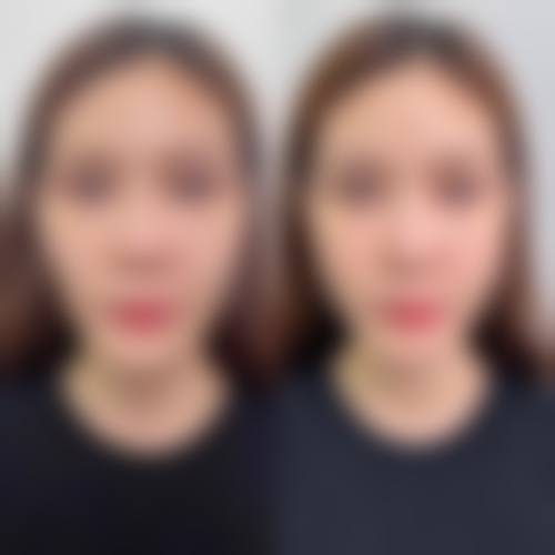 卢林凤医生吸脂整形怎么样可靠吗？